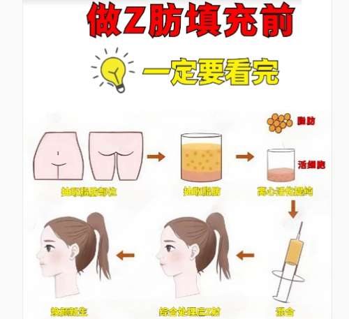 温州脂肪填充哪个医生好?医生详细详细内容!插图4 温州脂肪填充哪个医生好?医生详细详细内容!插图4