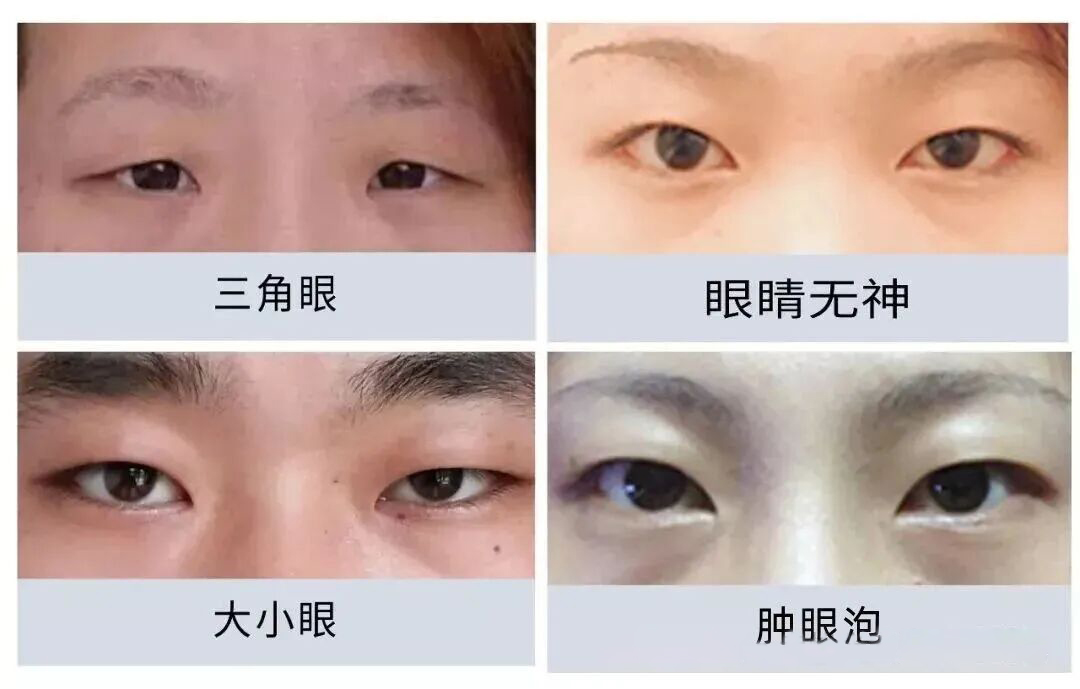 想做双眼皮手术？这些干货知识你要知道！插图2