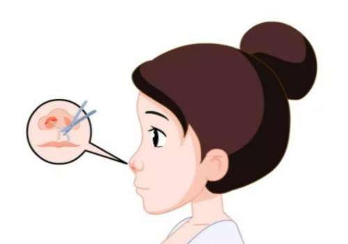 牟广隆医生做鼻子怎么样?20年经历+千例鼻子0差评,附最新价格插图3 牟广隆医生做鼻子怎么样?20年经历+千例鼻子0差评,附最新价格插图3