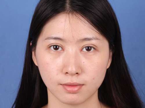 何元飞双眼皮手术案例分析插图2 何元飞双眼皮手术案例分析插图2