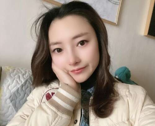 重庆曹阳医生双眼皮修复案例分析插图3