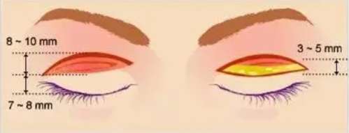 天津眼科医院整形科专家有几个都是谁？陈文莉、陈遐、李浩晴等实力不俗！插图3