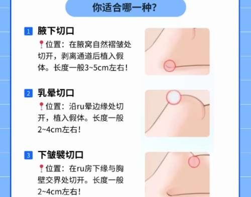 合肥脂肪隆胸医生排名情况!医生积累了丰富的理论知识!插图4 合肥脂肪隆胸医生排名情况!医生积累了丰富的理论知识!插图4
