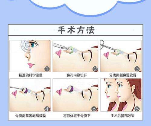 段焘医生做鼻子做得好吗?技术优势_野生案例_2026最新价格插图1 段焘医生做鼻子做得好吗?技术优势_野生案例_2026最新价格插图1