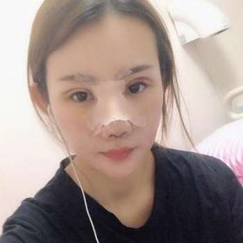 黄开亮医生做修复鼻子怎么样？技术点评、医生介绍、手术风格、案例插图3