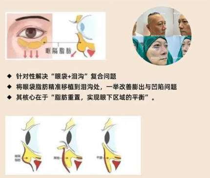 深圳去眼袋哪个医生比较好？魏鹏、李天石等专家实力在线！插图4