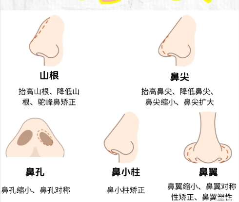 美贝尔童列健医生怎么样?做鼻子费用高吗?案例赏析插图4 美贝尔童列健医生怎么样?做鼻子费用高吗?案例赏析插图4