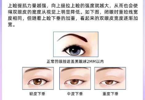 哈尔滨双眼皮修复好的医生名单!医生技术掌握到位!名气不容小觑插图4 哈尔滨双眼皮修复好的医生名单!医生技术掌握到位!名气不容小觑插图4