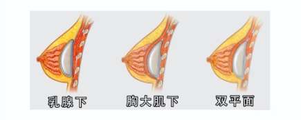 合肥隆胸医生排名推荐!一键戳进来看详情介绍插图4 合肥隆胸医生排名推荐!一键戳进来看详情介绍插图4