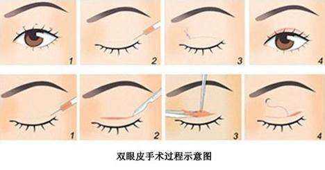 合肥孟松和耿继龙谁厉害?双眼皮专家实力比拼!价格3000元起!插图 合肥孟松和耿继龙谁厉害?双眼皮专家实力比拼!价格3000元起!插图