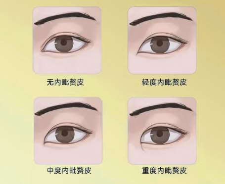 金华双眼皮修复好的医生有哪些?医生名单揭秘!插图4 金华双眼皮修复好的医生有哪些?医生名单揭秘!插图4