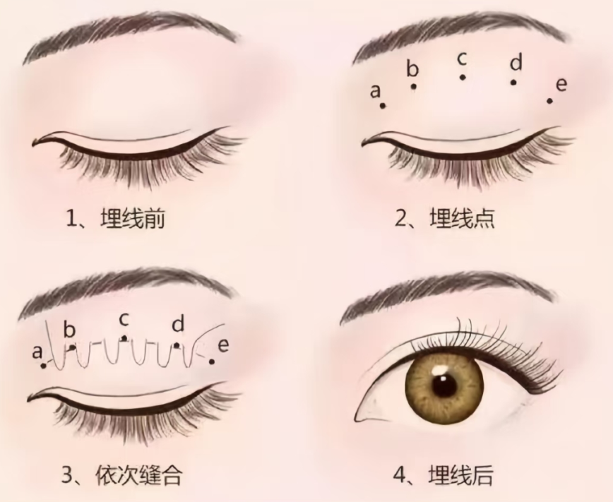 双眼皮手术：科学认知与理性选择指南插图