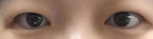 双眼皮手术必须要去皮去脂吗？插图