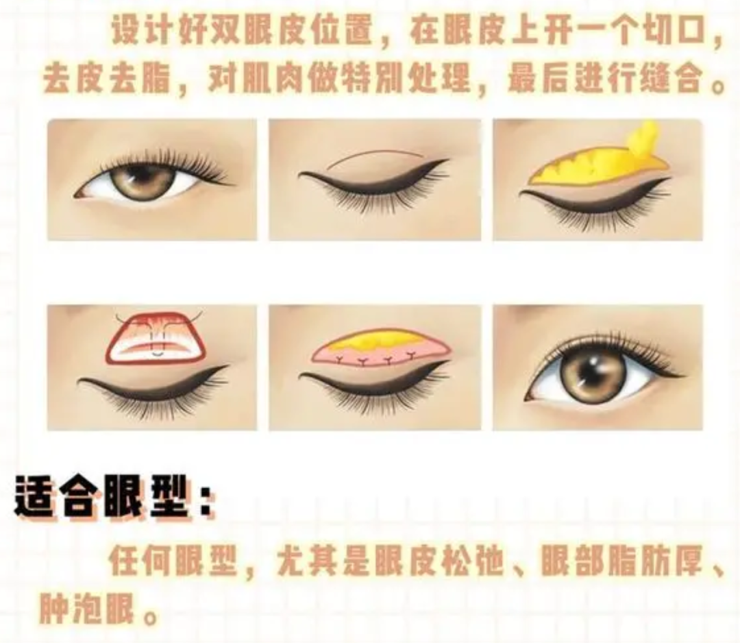 做“双眼皮”前一定要知道的事，少走弯路！插图1
