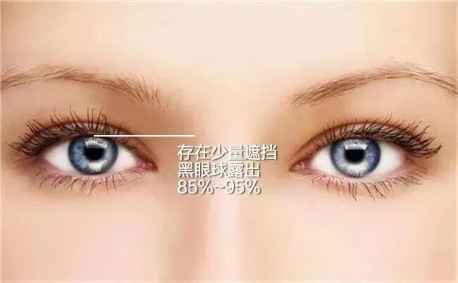 做双眼皮手术一定要提肌吗？插图1