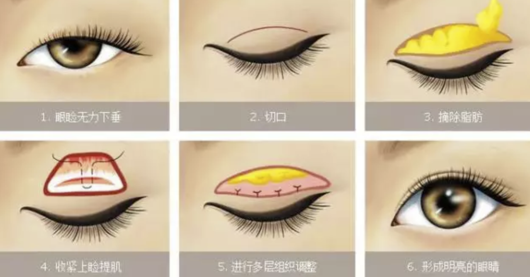 做“双眼皮”前一定要知道的事，少走弯路！插图6