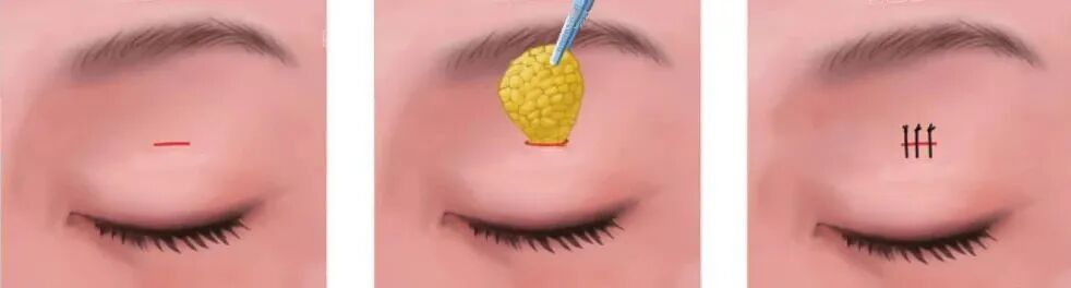 双眼皮手术真的能做到无痕吗？插图1