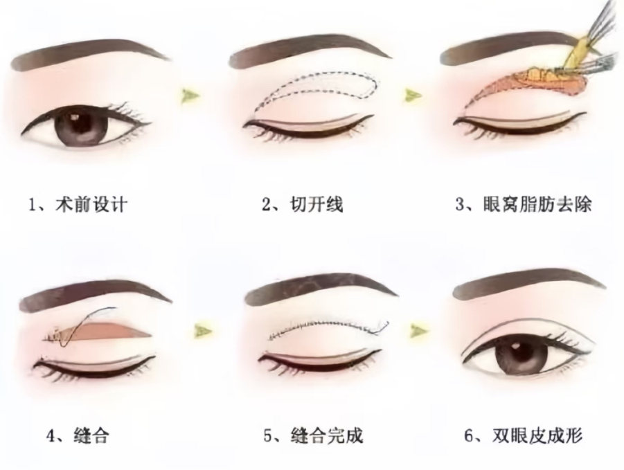 双眼皮手术：科学认知与理性选择指南插图1