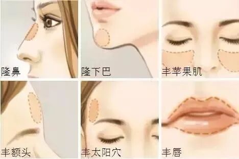 北京玻尿酸除皱哪家医院好?青春延迟的秘密插图1 北京玻尿酸除皱哪家医院好?青春延迟的秘密插图1