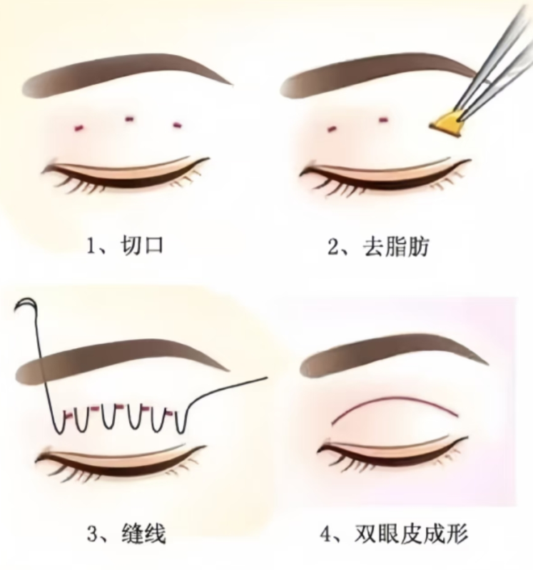 双眼皮手术：科学认知与理性选择指南插图2