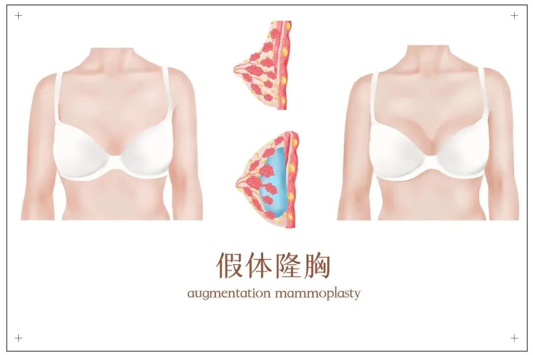 假体丰胸手术是否能以假乱真？插图1