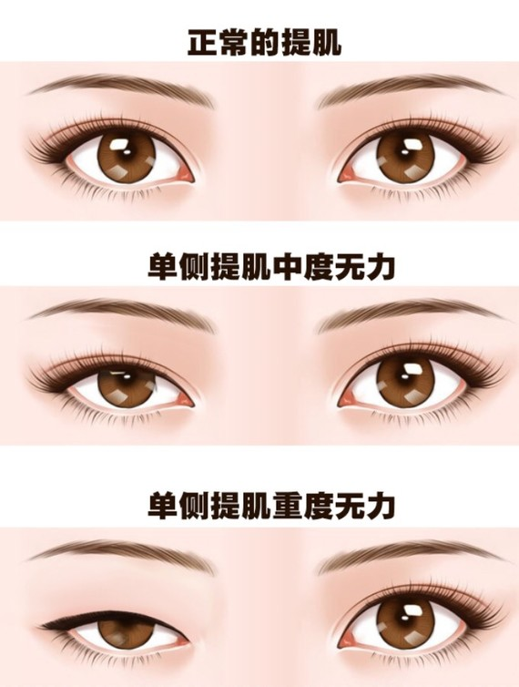 做双眼皮手术一定要提肌吗？插图