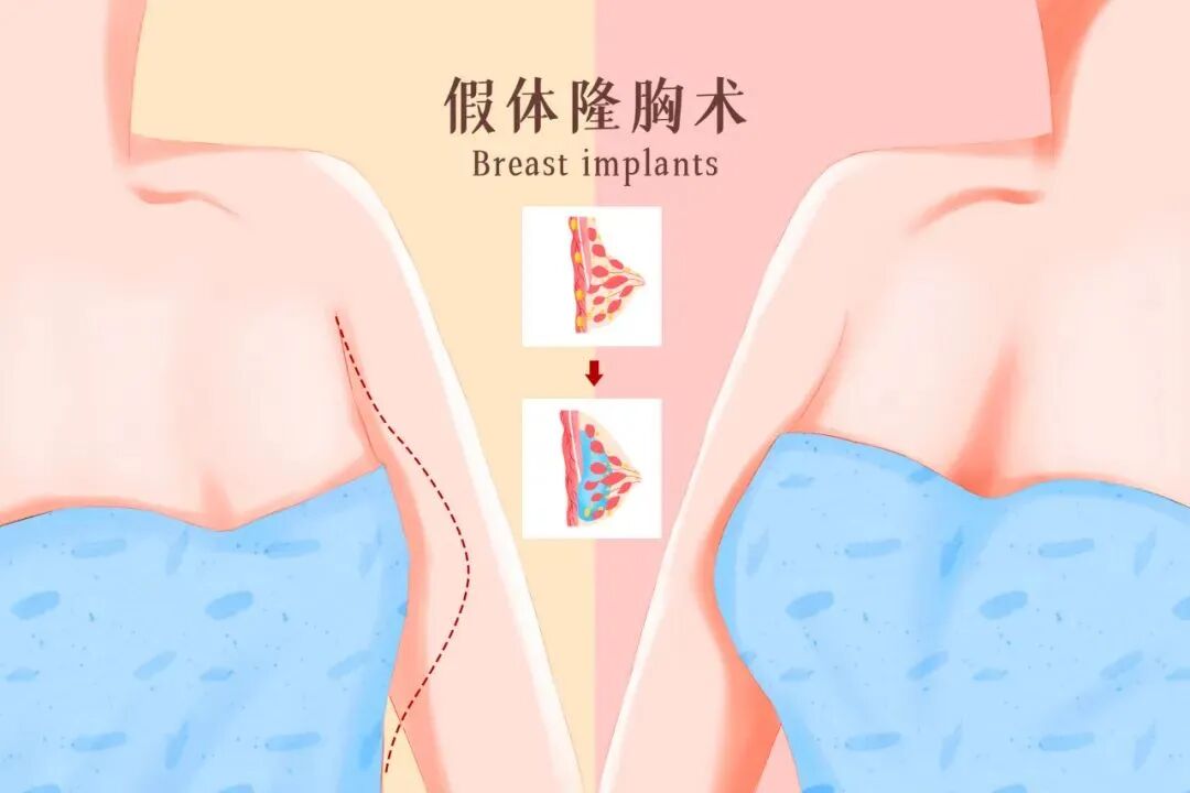 假体丰胸手术是否能以假乱真？插图3
