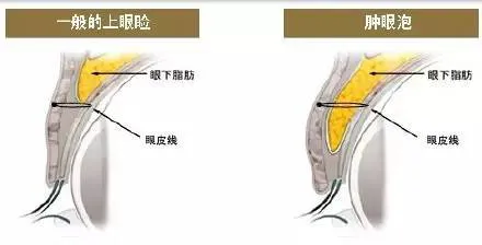双眼皮手术损伤越小越好吗？插图