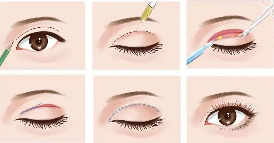 双眼皮整形手术有哪几种方式？如何选择适合自身的方式插图