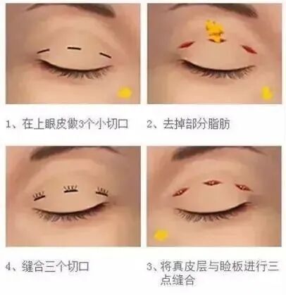 双眼皮整形手术有哪几种方式？如何选择适合自身的方式插图2