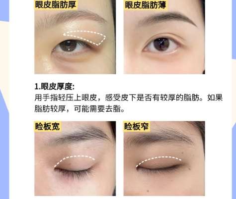 青岛去眼袋好的医生都有谁？王志国、王彦进、苏毅鹏等实力超群！插图4