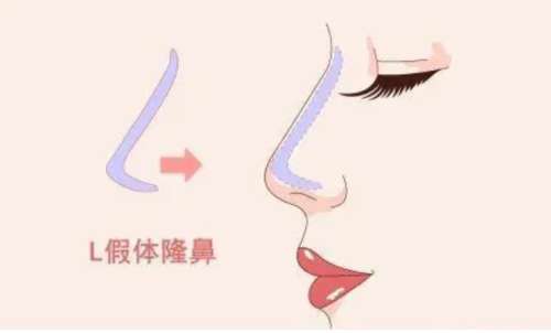 广州崔东做鼻子技术怎么样有人做过吗?真实做鼻部项目流程分析!插图3 广州崔东做鼻子技术怎么样有人做过吗?真实做鼻部项目流程分析!插图3