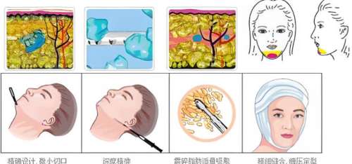 北京吸脂修复谁好?王明利|任学会|刘中国等是比较不错的医生!插图3 北京吸脂修复谁好?王明利|任学会|刘中国等是比较不错的医生!插图3