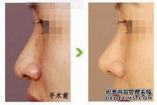 自体软骨隆鼻效果好吗?自体软骨隆鼻效果怎么样?插图1