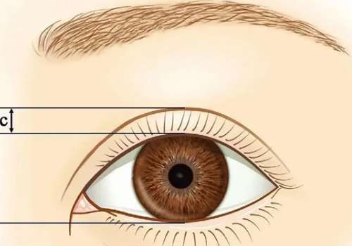 李学拥眼修复怎么样？双眼皮修复强，医生简介 | 手术案例分享插图3