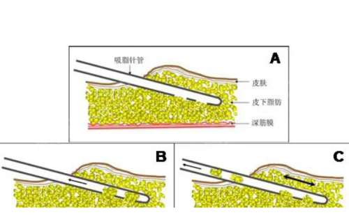 中南大学湘雅医院谭骛远抽脂术后半年经典案例分析插图2 中南大学湘雅医院谭骛远抽脂术后半年经典案例分析插图2