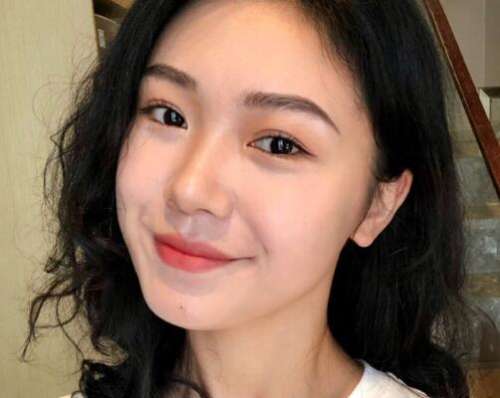 李秀琪眼袋案例分析插图3
