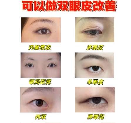 沈阳双眼皮修复厉害的医生是谁?恒莉、李梦颖这几位都是技术流!插图4 沈阳双眼皮修复厉害的医生是谁?恒莉、李梦颖这几位都是技术流!插图4