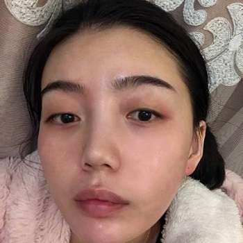 黄金龙医生双眼皮案例,术后和小眼睛差别很大,真的是水汪汪!插图1 黄金龙医生双眼皮案例,术后和小眼睛差别很大,真的是水汪汪!插图1