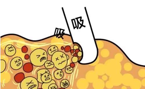 河南省人民医院靳君抽脂120天变美案例分析插图1 河南省人民医院靳君抽脂120天变美案例分析插图1