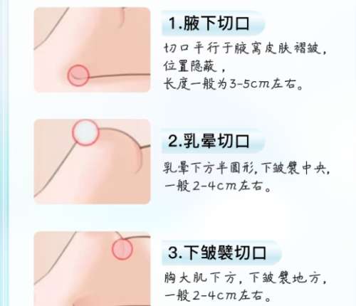 福州假体隆胸比较厉害的医生!附术后注意事项详细介绍插图4 福州假体隆胸比较厉害的医生!附术后注意事项详细介绍插图4