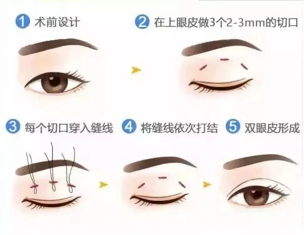 想做双眼皮手术？这些干货知识你要知道！插图9