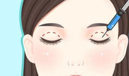 太原双眼皮范婷医生技术如何？真人案例、风格解析、预约攻略！插图3