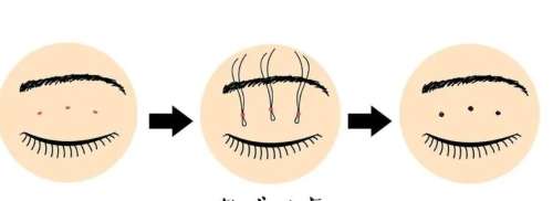 沈阳百嘉丽侯亚杰做的双眼皮好吗?技术靠谱吗?真实案例分析插图4 沈阳百嘉丽侯亚杰做的双眼皮好吗?技术靠谱吗?真实案例分析插图4