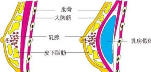 南京夏建军和郑州刘清亮做假体隆胸手术哪个好?技术优势对比!插图4 南京夏建军和郑州刘清亮做假体隆胸手术哪个好?技术优势对比!插图4