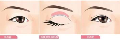 黄良飞双眼皮修复怎么样?医生口碑测评+真实评价来袭!插图1 黄良飞双眼皮修复怎么样?医生口碑测评+真实评价来袭!插图1