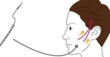 冯立哲面部提升怎么样?面部提升案例分析插图3 冯立哲面部提升怎么样?面部提升案例分析插图3