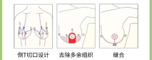 上海脂肪隆胸谢芸医生简介!医生口碑评价|最新价格参考!插图4 上海脂肪隆胸谢芸医生简介!医生口碑评价|最新价格参考!插图4