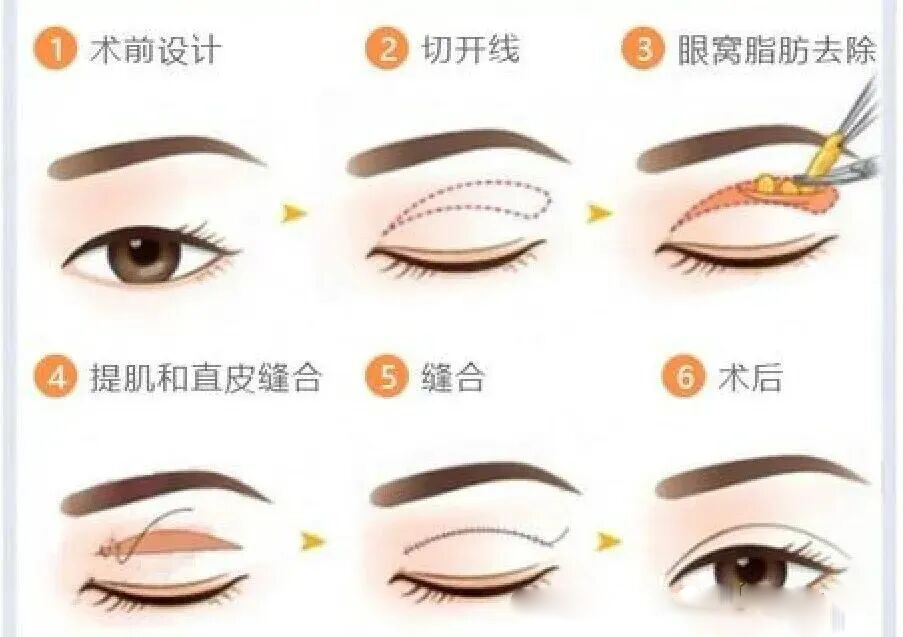 想做双眼皮手术？这些干货知识你要知道！插图10