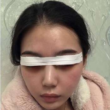 黄金龙医生双眼皮案例,术后和小眼睛差别很大,真的是水汪汪!插图2 黄金龙医生双眼皮案例,术后和小眼睛差别很大,真的是水汪汪!插图2